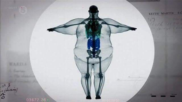 A full Body Xray of a very obese person showing how tiny their skeleton really is.